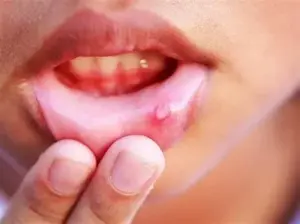 7 Cara ampuh mengatasi sariawan