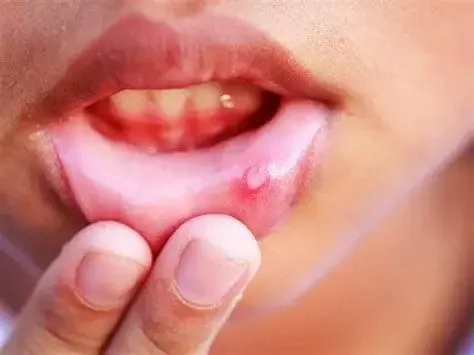 7 Cara ampuh mengatasi sariawan