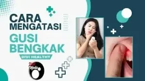 Cara Mengatasi Gusi Bengkak