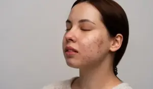 Ilustrasi bekas jerawat pada wajah. Foto: Freepik