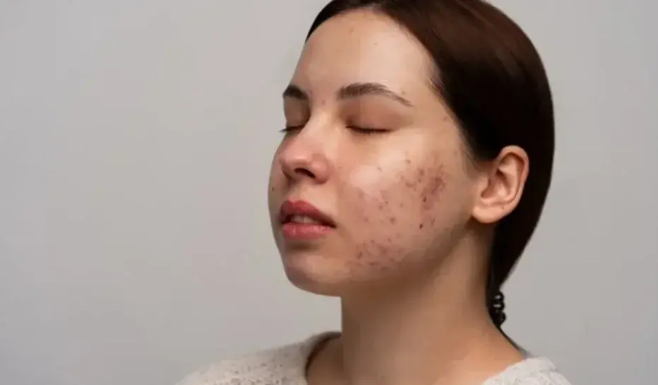 Ilustrasi bekas jerawat pada wajah. Foto: Freepik