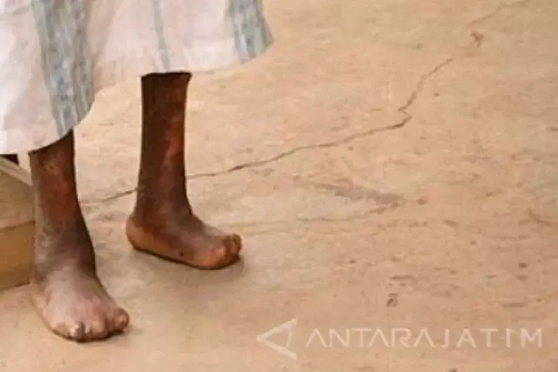 Ilustrasi - Penderita kusta (FOTO ANTARA/Abdul Aziz)