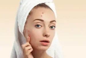 Ilustrasi kulit berjerawat. Foto: Freepik